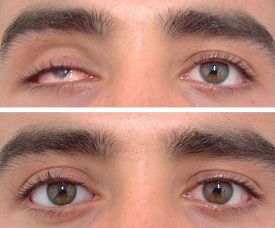 Ottica Garagnani - Protesi oculari